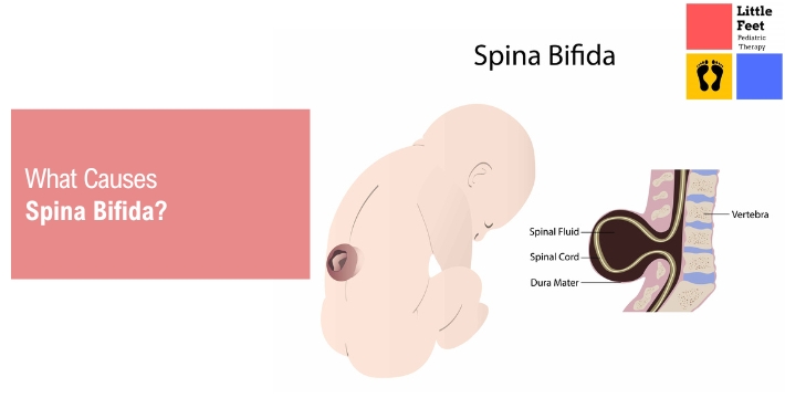 What Causes Spina Bifida? | Little Feet Therapy | Pediatric Occupational Therapy Pediatric Physical Therapy Clinic | Washington DC, Charlotte NC, Raleigh NC, St Louis MO