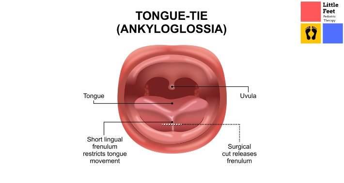 Tongue-tie and Mouth Breathing | Little Feet Therapy | Pediatric Occupational Therapy Pediatric Physical Therapy Clinic | Washington DC, Charlotte NC, Raleigh NC, St Louis MO